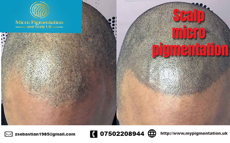 Micro pigmentation and scalp UK| Micro pigment tattoo